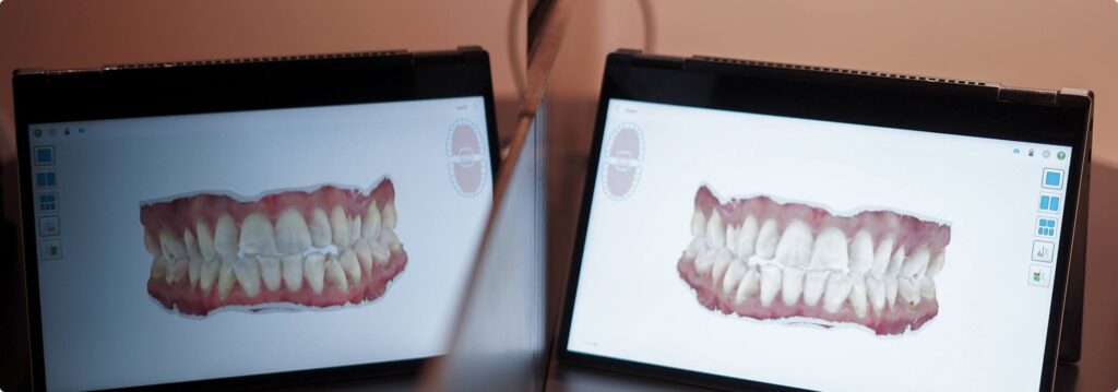 Scanner intraoral ortodoncia alineadores Madrid